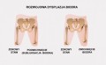 Obustronna orteza stawu biodrowego z regulacją zakresu ruchomości stawów oraz regulacją długości szyn udowych AM-SB 1RE VIPER DUAL  - 4MEDIC.jpg
