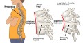 Pediatryczna orteza kręgosłupa strada FIX-T-02   -  REH4MAT.jpg